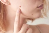 Bliss Skin Tag Remover Review: Is It Worth The Hype?